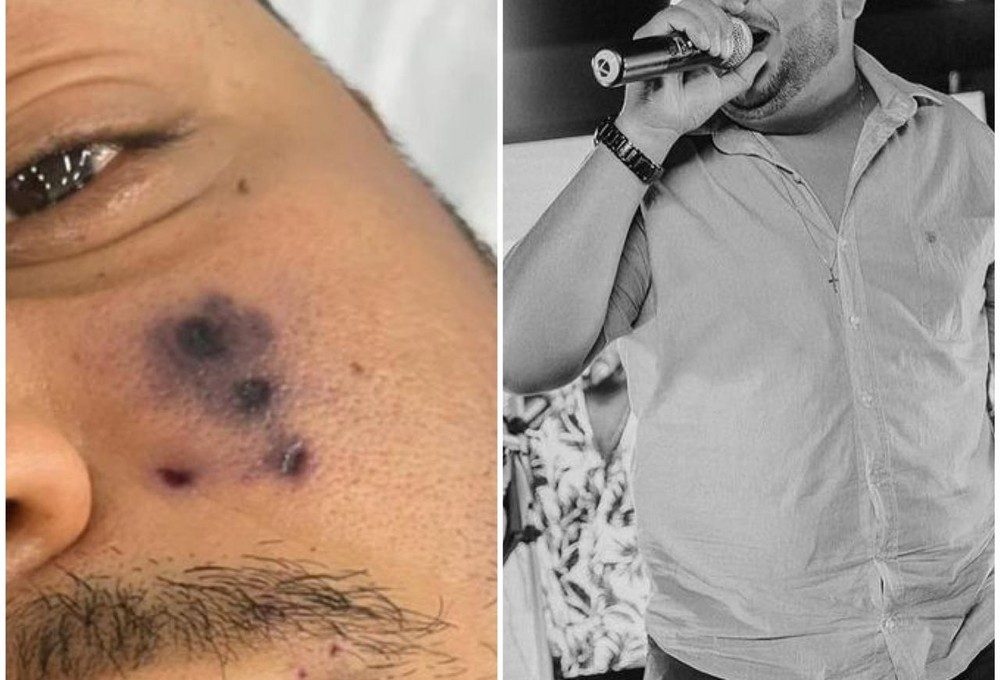 Cantor morre após ser picado por aranha no rosto — Foto: Arquivo Pessoal